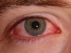 Read more about the article Conjunctivitis-Pinkeye / आँख आना और उसका इलाज