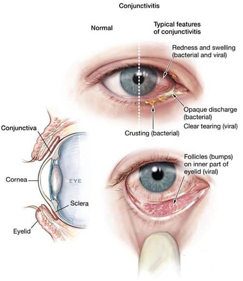 Conjunctivitis-Pinkeye