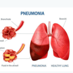 Pneumonia in Children