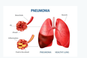 Read more about the article Pneumonia in Children / बच्चों में निमोनिया