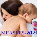 Measles Symptoms and Treatment