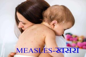 Read more about the article Measles Symptoms and Treatment-खसरा Measles (Rubella)