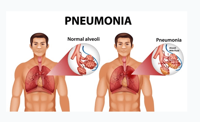 Pneumonia in Children