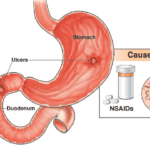 Peptic Ulcer / Gastric Ulcer