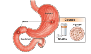 Read more about the article Peptic Ulcer – पेट में अल्सर (छाले)