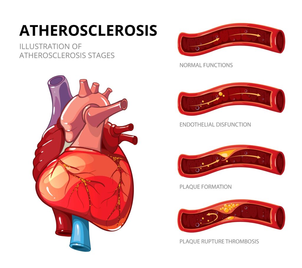 Heart Attack and Atherosclerosis